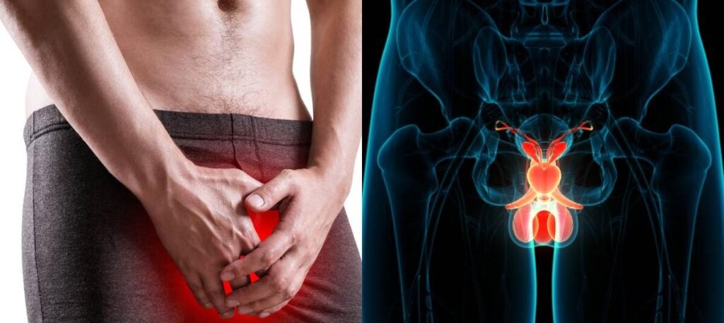 Tratamiento para Cáncer de Pene en Guadalajara